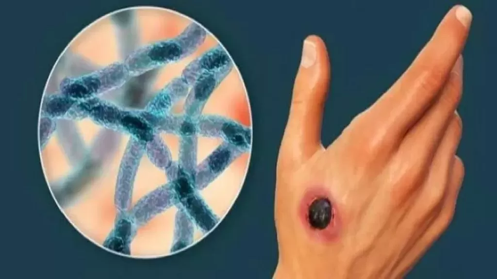 الصحة العالمية تعلن تفشي مرض الجمرة الخبيثة في هذه البلد